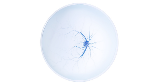 Glaucoma Workflow