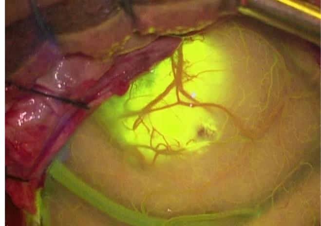 Modernidad en visualización en Neurocirugía: Fluorescencia Intraoperatoria YELLOW 560