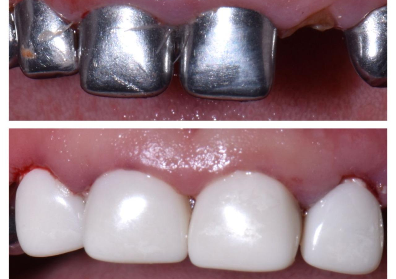 RESTAURACIÓN ESTÉTICAS EN DIENTES PRIMARIOS, CORONAS PEDIÁTRICAS DE ZIRCONIA