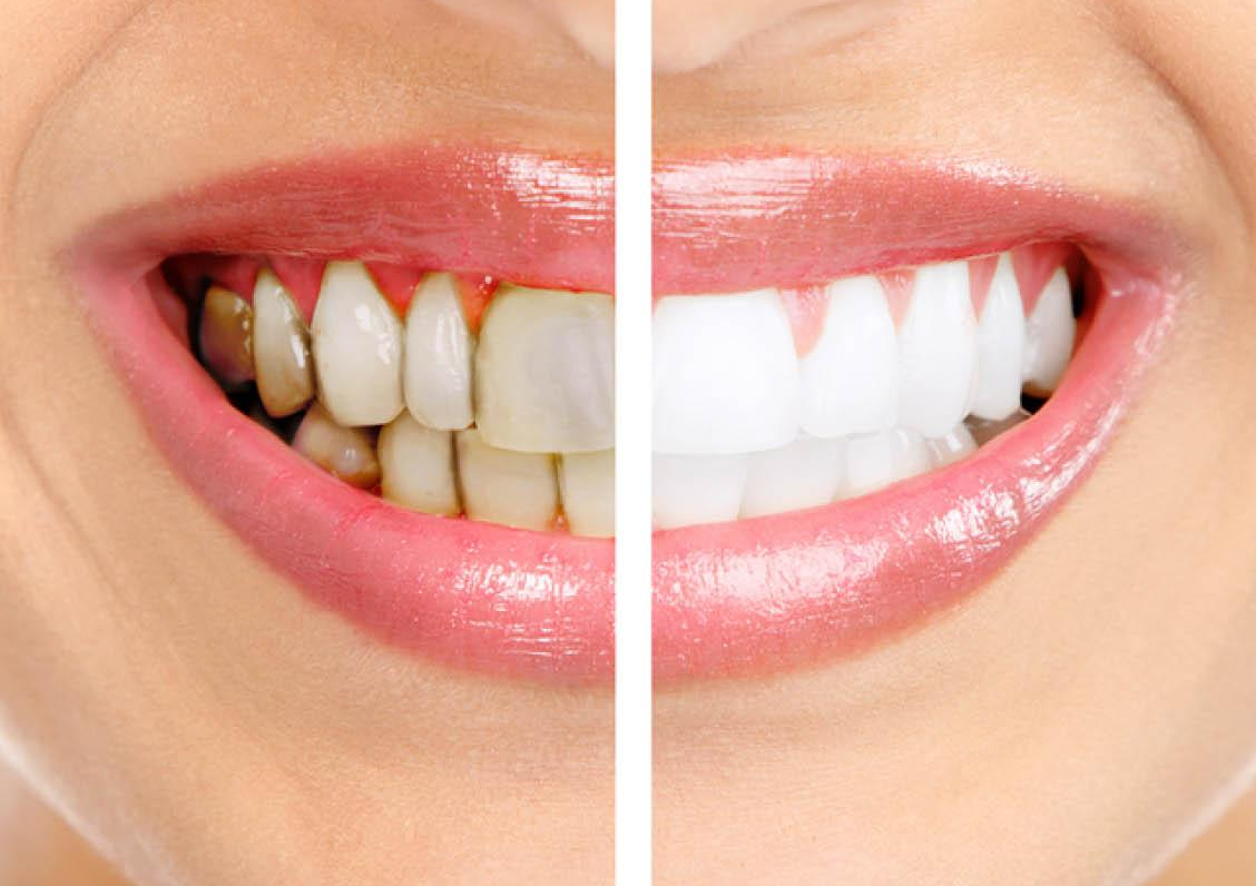 Чем снять воспаление десен в домашних условиях. Профессиональная чистка зубов до и после.